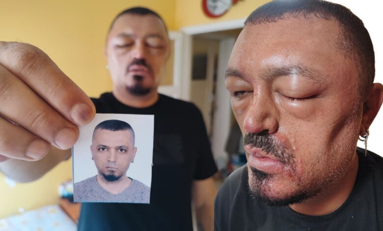 Berber tavsiyesi hastanelik etti! Saç siyahlaştırıcı şampuan hayatını kabusa çevirdi