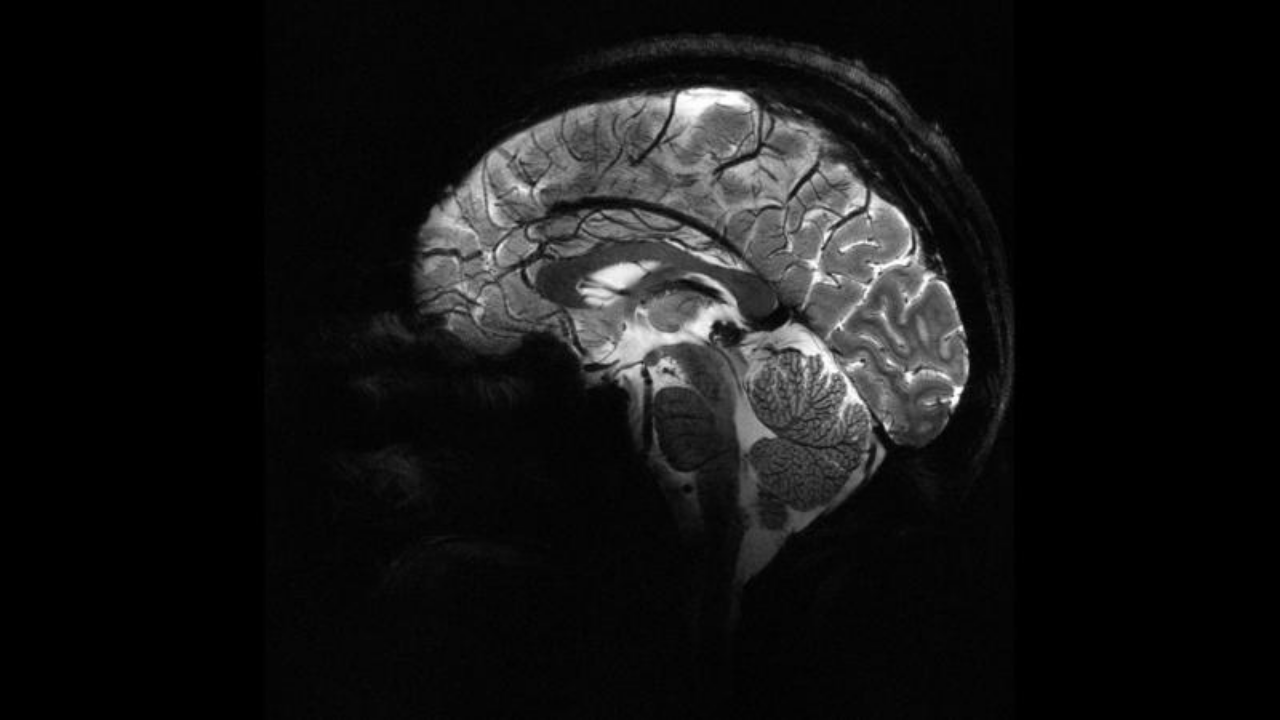 Yapay zeka, epilepsili çocuklarda doktorların gözden kaçırdığı gizli lezyonları buldu Yapay zeka, epilepsili çocuklarda doktorların gözden kaçırdığı gizli lezyonları buldu